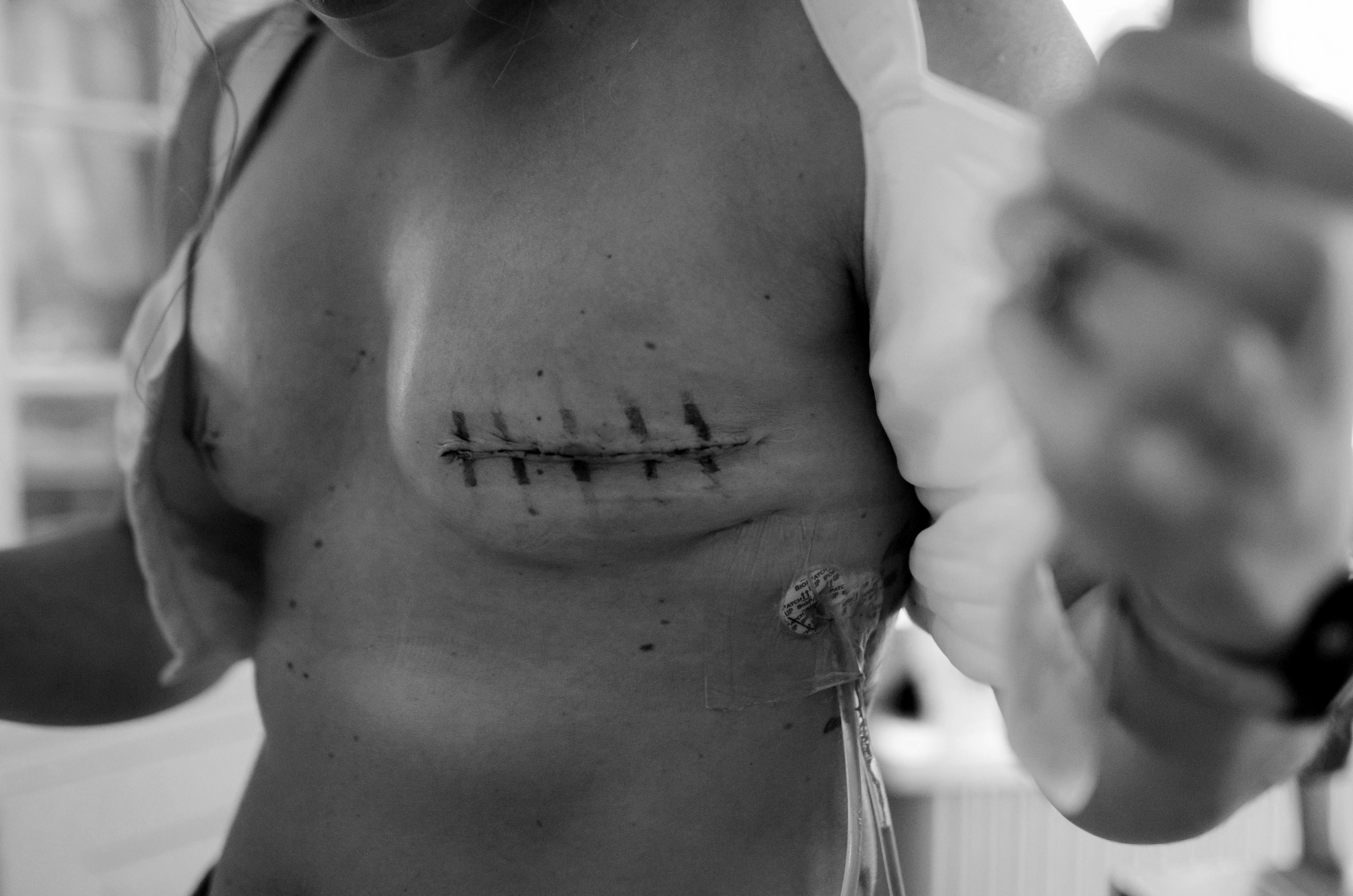 double mastectomie, cicatrices sur un torse de femme